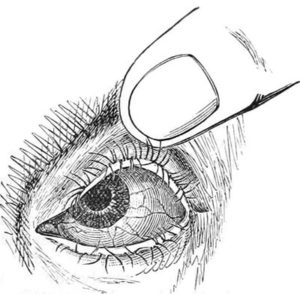 sw-Zeichnung: Augenarzt hebt mit seinem Finger das Augenlid an